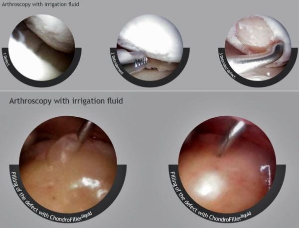 ChondroFiller3