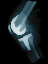 endoproteza-kolana-sport-klinika-zory